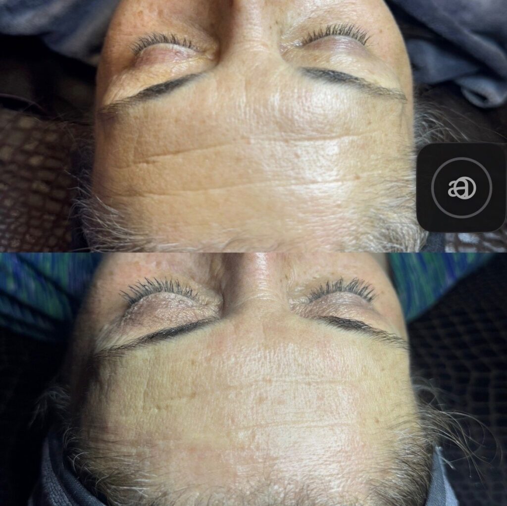 Microneedling Before and After: Real Results at Exotica skin care Henderson