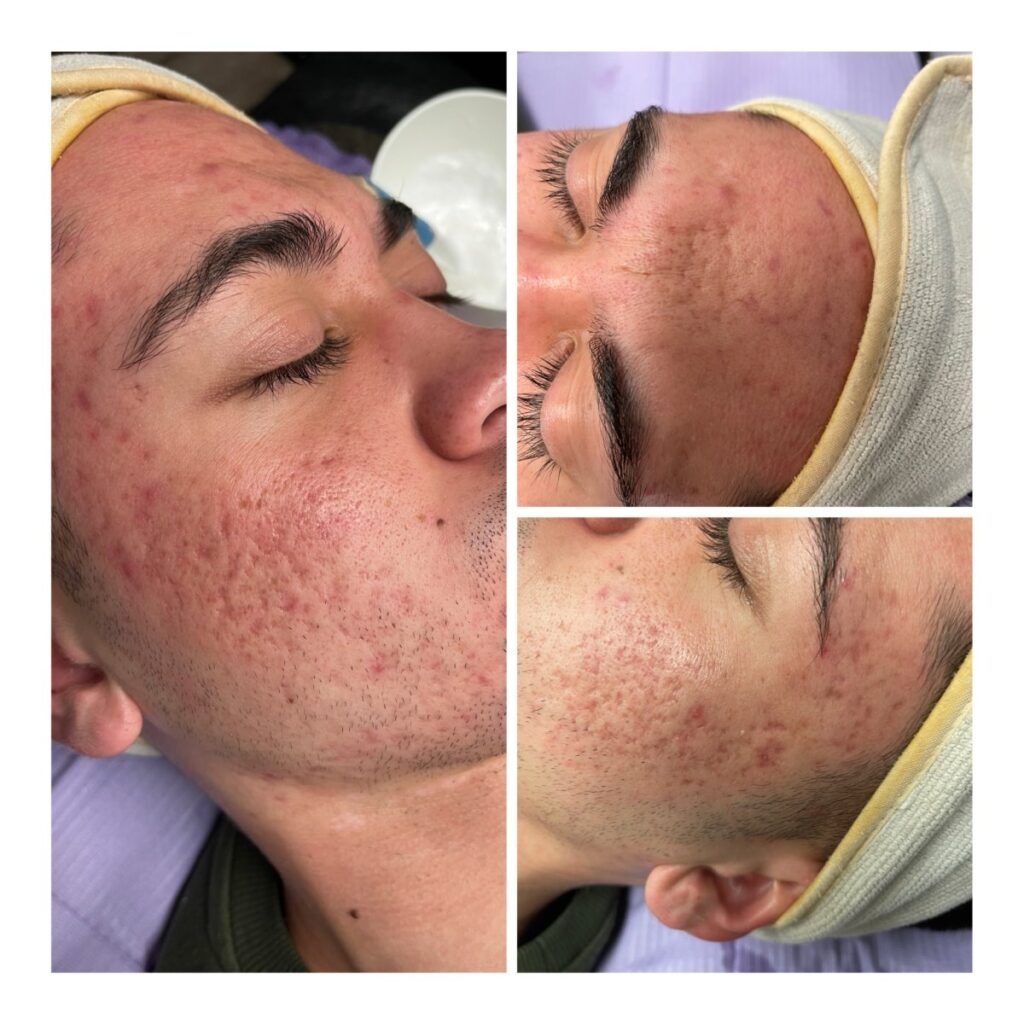 BioRePeel vs Vi Peel: The Low-Downtime Revolution at Exotica skin care Henderson