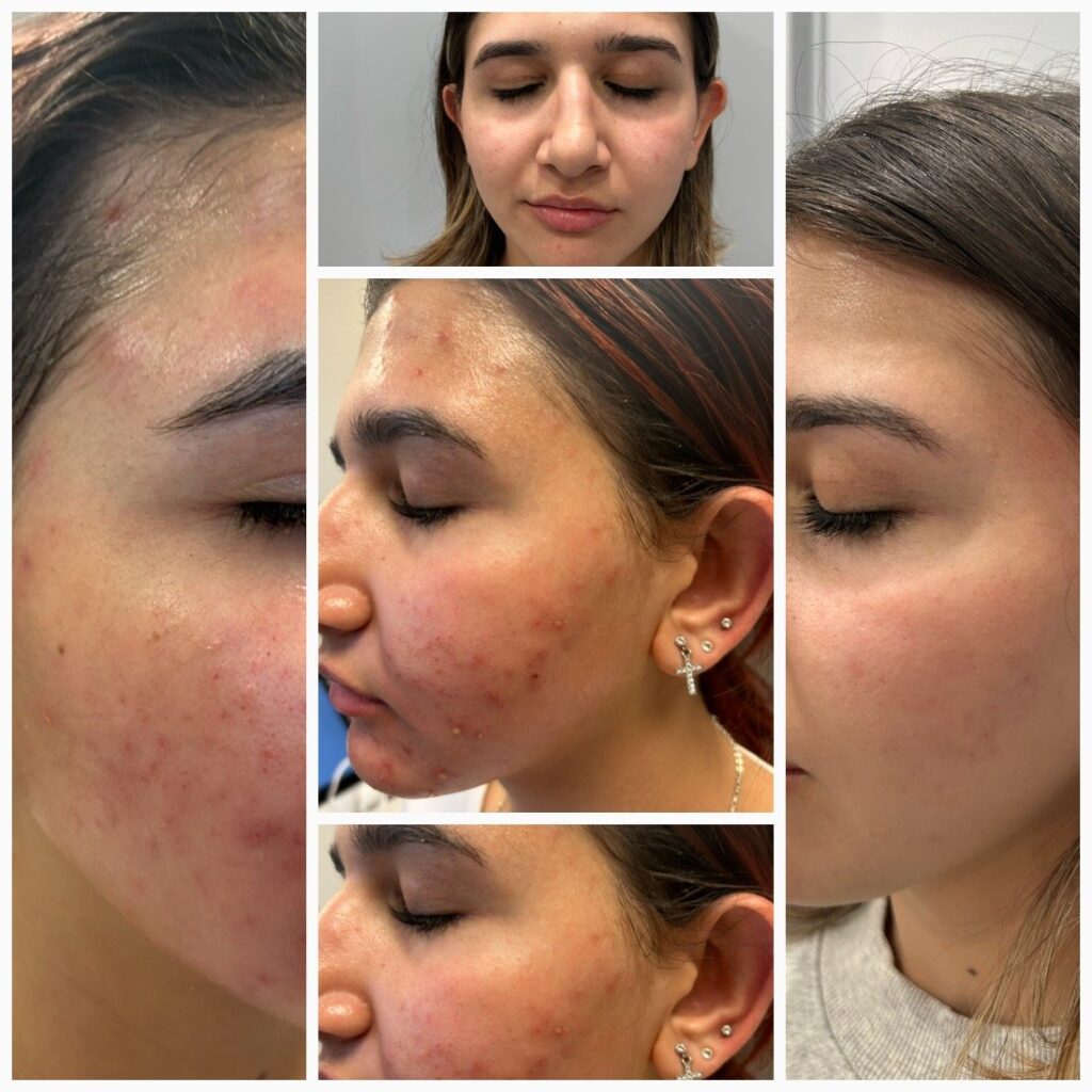 Expert Acne Specialist Las Vegas: Clear Skin Starts Here