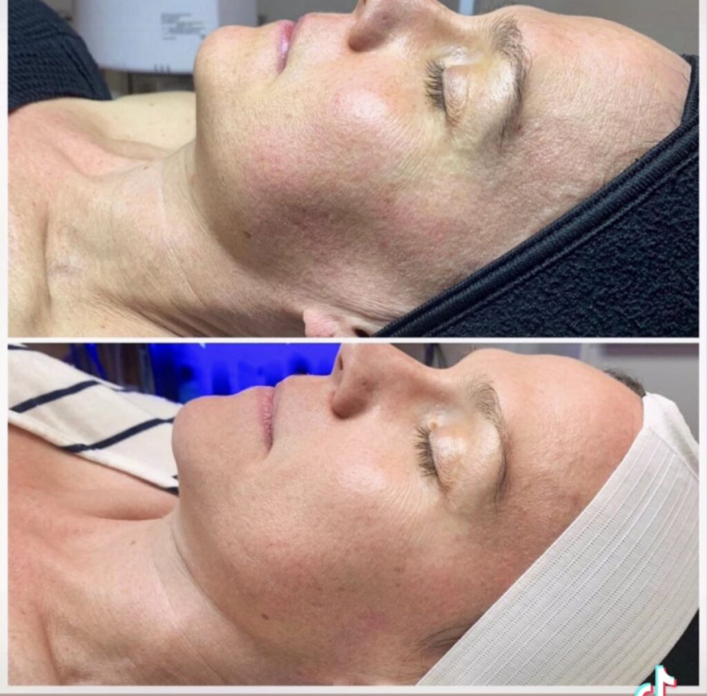 Carbon Peel Facial Henderson: The Ultimate Hollywood Glow at Exotica Skin Care (2026)
